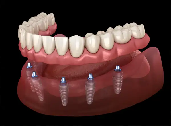 Non-Invasive Composite Veneers